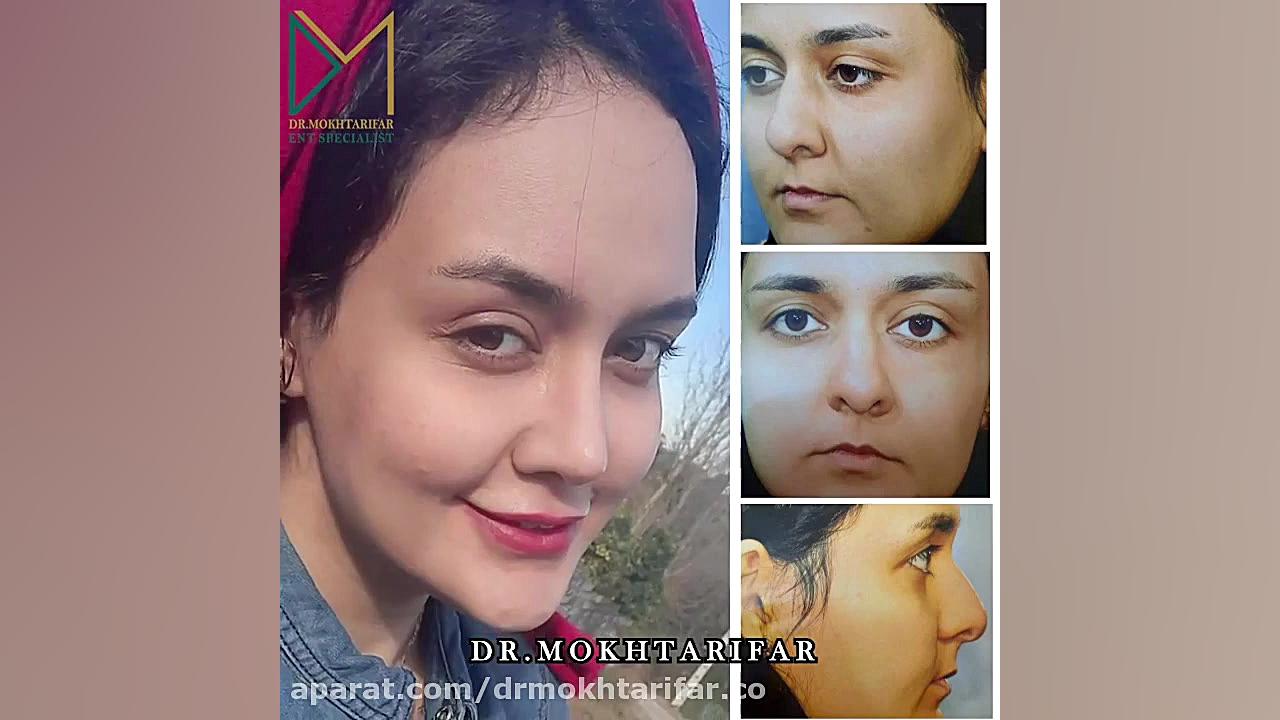 حدود یک سال پس از جراحی زیبایی بینی به سبک نچرال استتیک دکتر فاطمه مختاری فر جراح بینی در لرستان