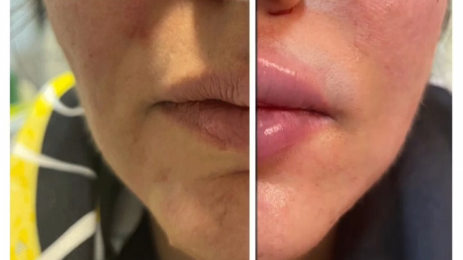 تزریق فیلر لب قبل و بعد دکتر سار ا لطفی