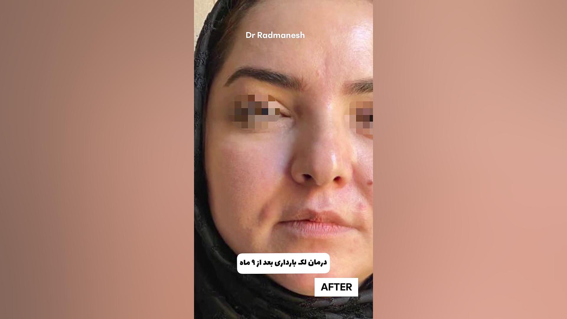 درمان لک بارداری بعد از 9 ماه پریودنتیکس