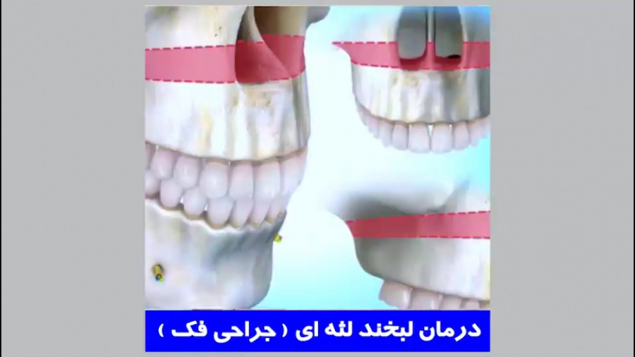 درمان لبخند لثه ای و جراحی فک | دکتر احسان ابوئی مهریزی نوروجراحی فانکشنال