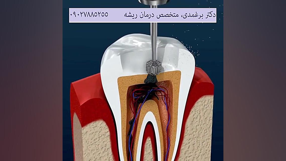 درمان ریشه و ترمیم دندان چگونه انجام می شود؟ NET-Seq
