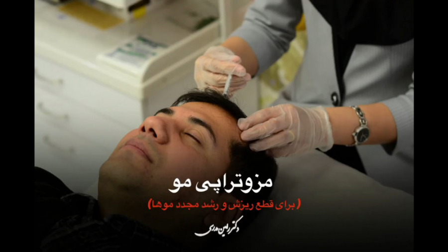 مزو تراپی مو برای جلوگیری از ریزش مو بیماری شوگرن