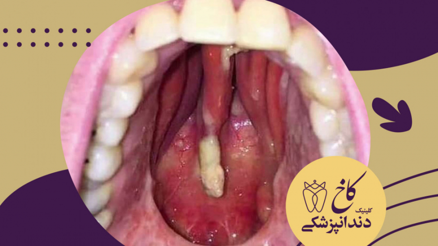 اثرات مصرف کوکائین بر دهان کلینیک دندانپزشکی کاخ