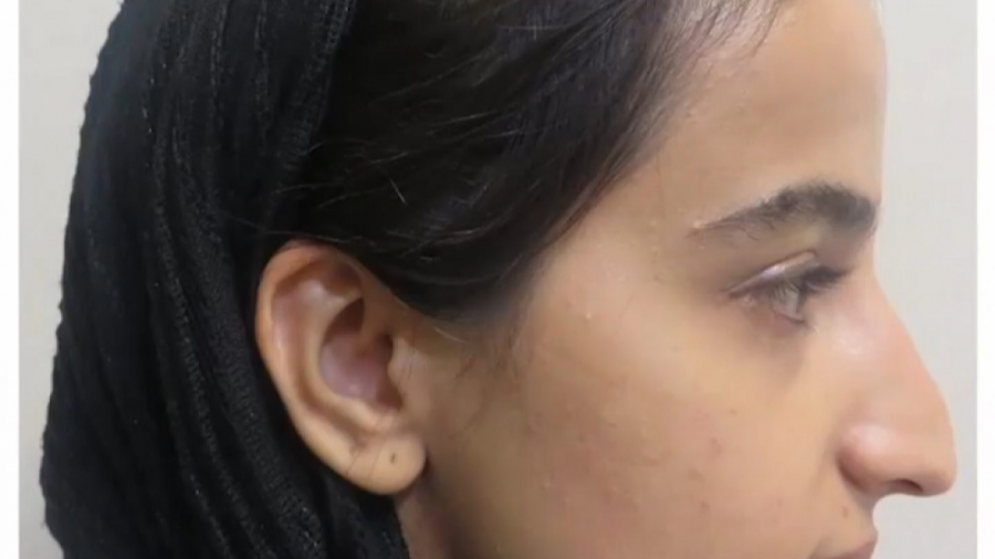 رضایتمندی از عمل رینوپلاستی مراجعه کننده دکتر محمودرضا اصحاب یمین - فوق تخصص پلاستیک