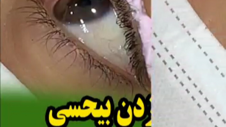 طریقه ی زدن بی حسی برای بن مژه پلاسماجت