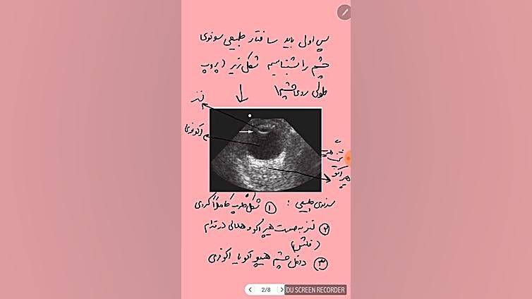 سونوگرافی چشم در اورژانس تزریق ژل