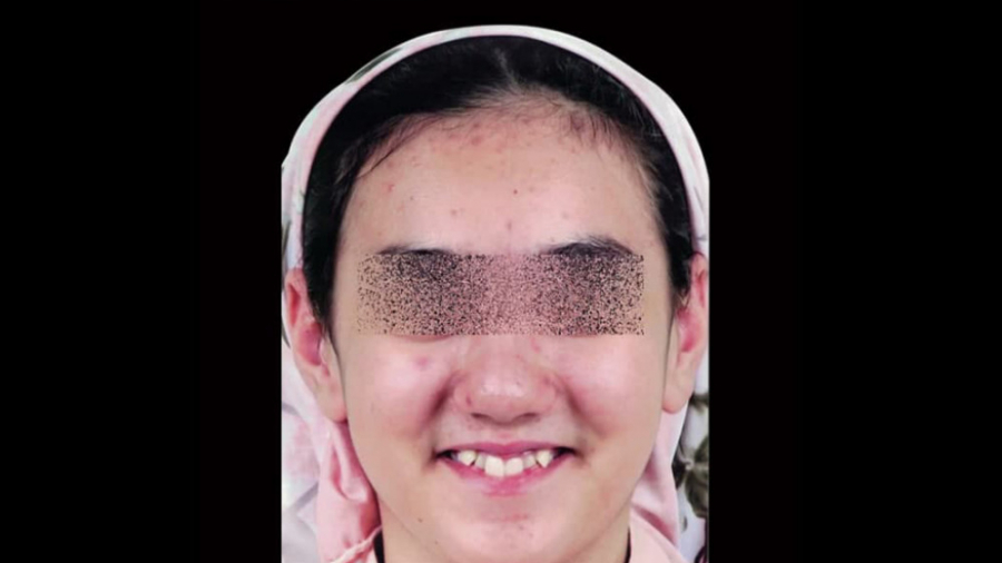 درمان ارتودنسی ثابت با کشیدن دو دندان آسیای کوچک در فک بالا دکتر برهمن سبزواری - متخصص ارتودنسی - مشهد