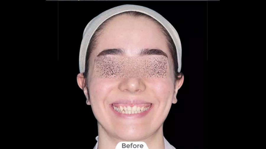 ارتودنسی ثابت فک بالا و پایین بدون کشیدن دندان دکتر برهمن سبزواری - متخصص ارتودنسی - مشهد