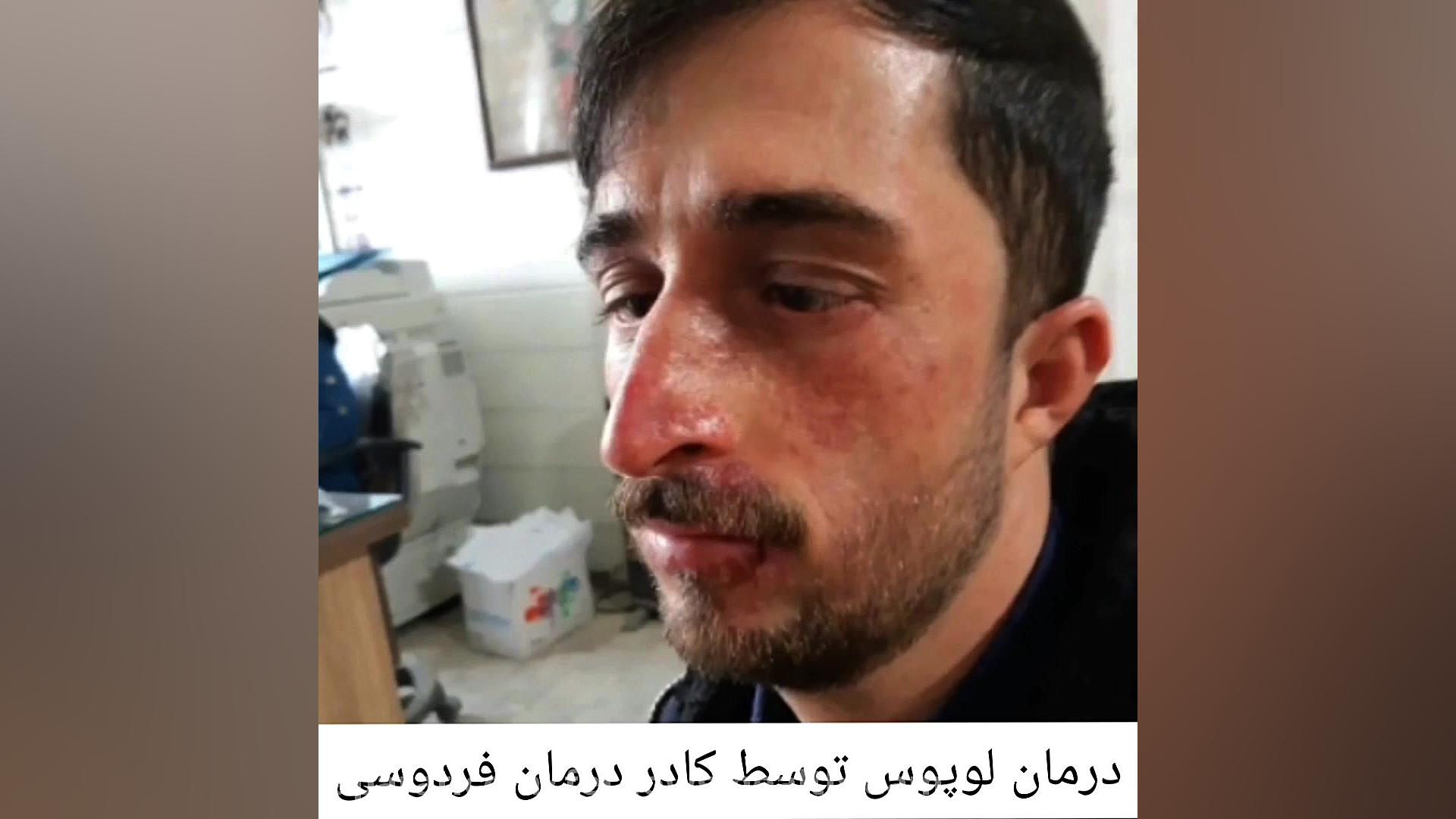اگر از لوپوس خسته شده اید حتما این ویدئو را ببینید!!! زاویه سازی صورت
