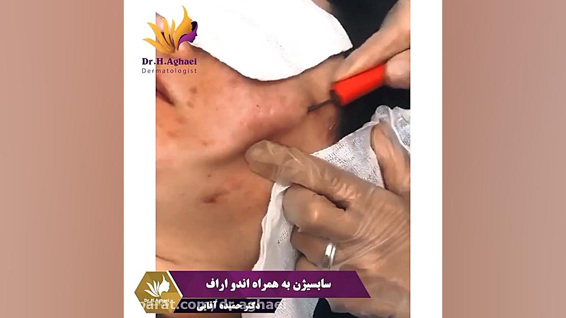 فیلم سابسیژن صورت به همراه اندو اراف دکتر حمیده آقایی