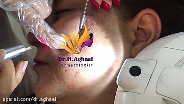 فیلم تخلیه غدد چربی صورت دکتر حمیده آقایی