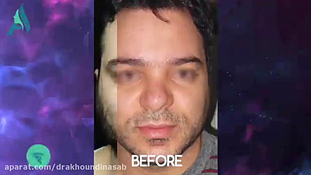 لیفت آندوسکوپی پیشانی دکتر محمدرضا آخوندی نسب-فوق تخصص جراحی پلاستیک