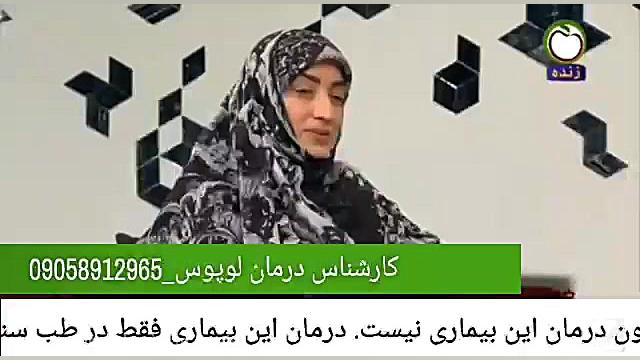 درمان قطعی لوپوس سیستمی بدون کورتون بلیچینگ دندان