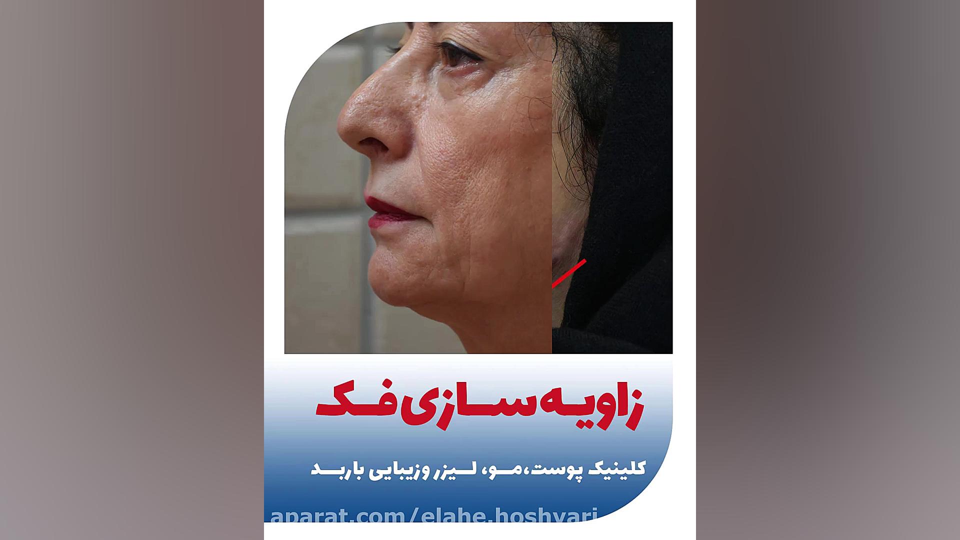 زاویه سازی و کانتورینگ صورت با تزریق فیلر برداشتن زگیل