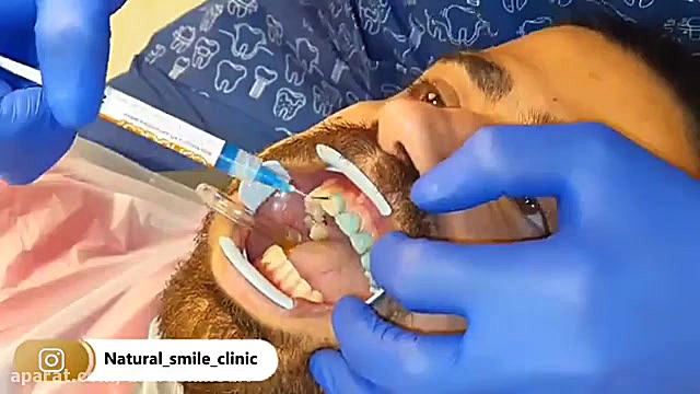 لمینیت سرامیکی، زیبایی دندان، دندانپزشکی ماکروسفالی