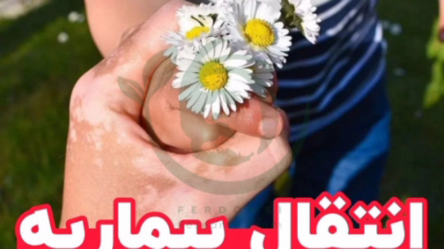 انتقال لک و پیس به فرزندان ویتیلیگو برص بهاق زلاتان ابراهیموویچ