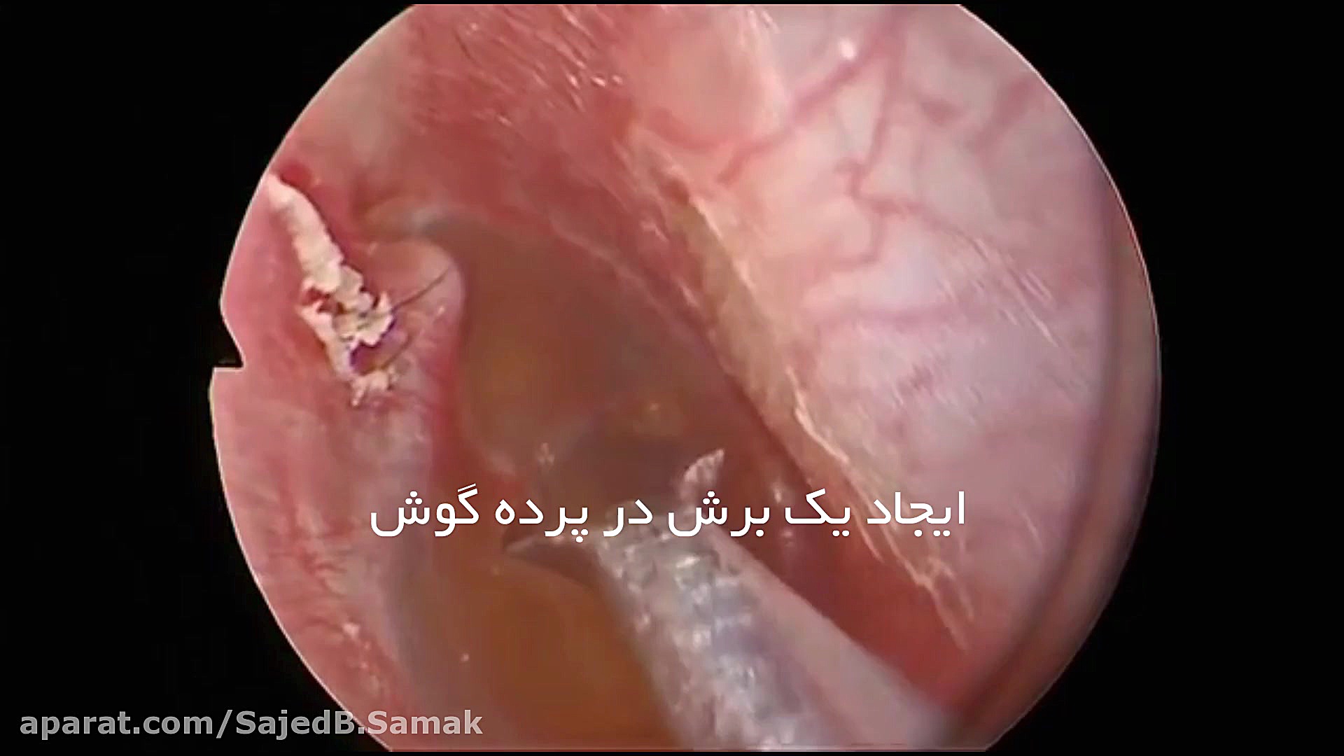لوله گذاری گوش ادیولوژیست ساجد بادفر