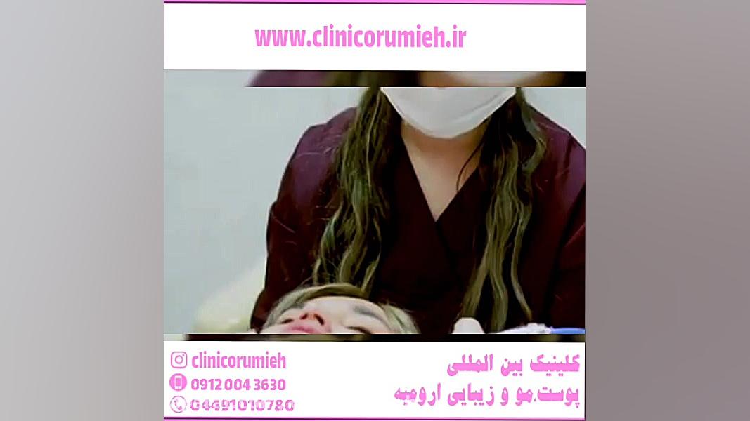 جوانسازی پوست صورت با لیزر آر اف فرکشنال NET-Seq