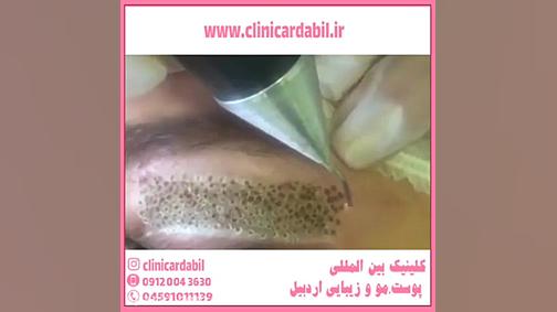 کاربرد ، مزایا و نتایج حیرت آور پلاسماجت تزریق بوتاکس