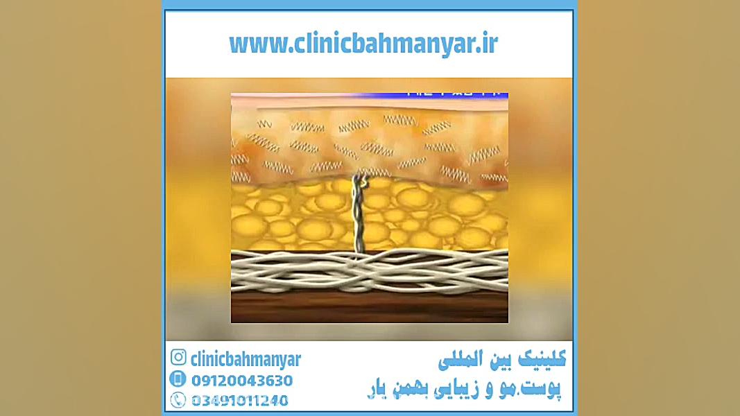 جوانسازی پوست صورت با لیزر آر اف فرکشنال جرمگیری
