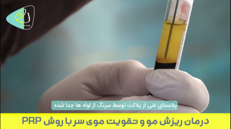 درمان ریزش مو و تقویت موی سر با روش PRP | لمون کلینیک دستگاه DNA-Chip