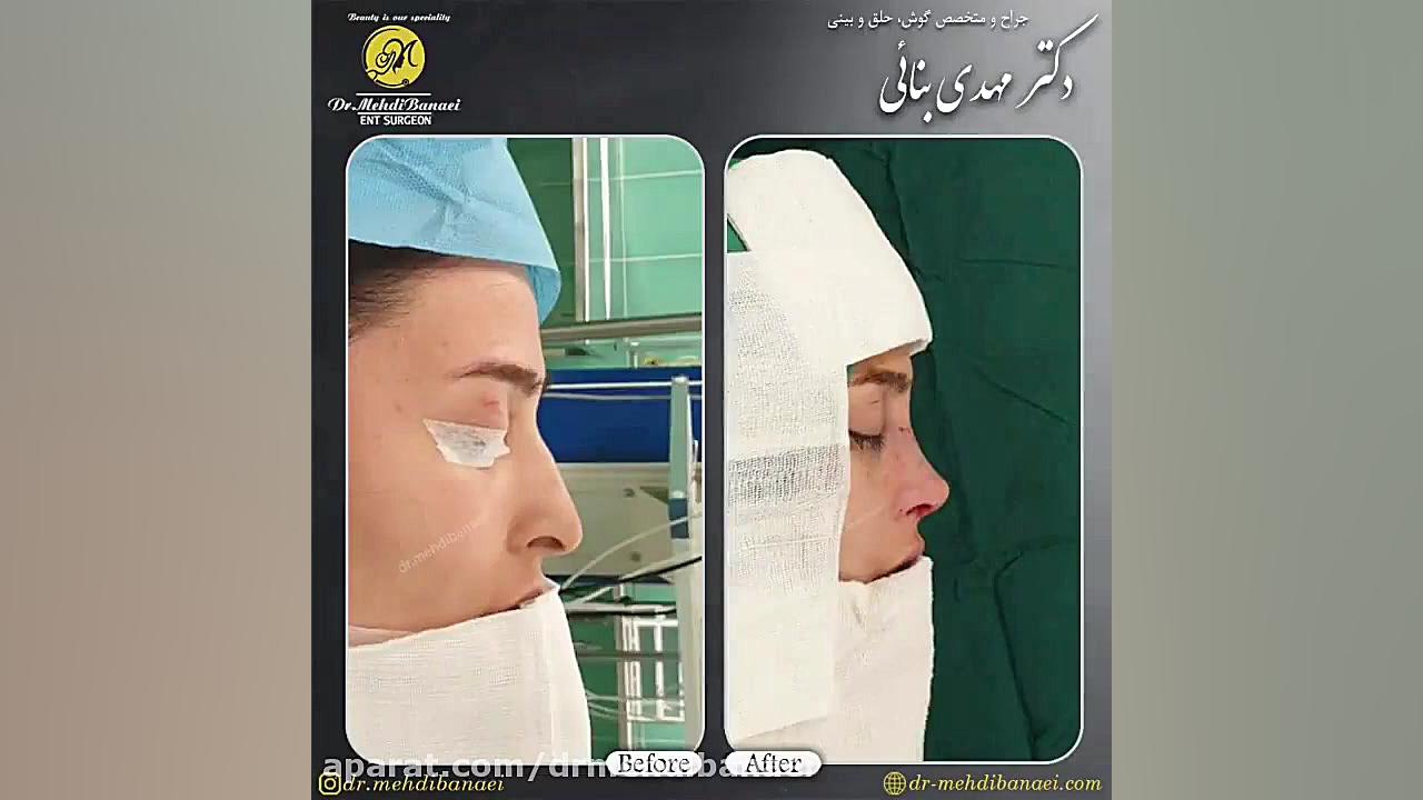 فیلم جراحی زیبایی بینی
