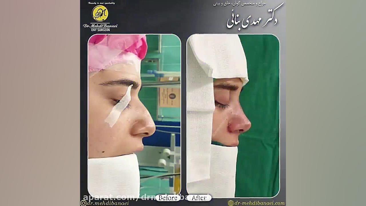 فیلم عمل زیبایی بینی