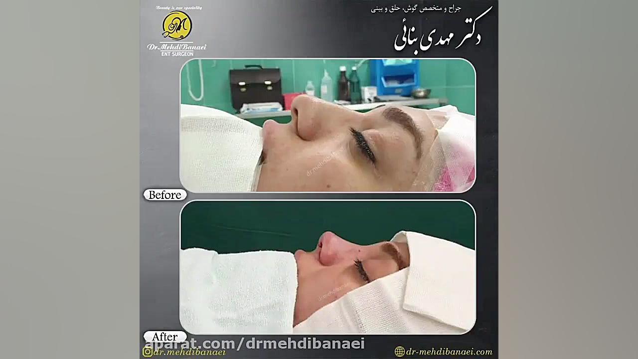 عمل زیبایی بینی و رفع افتادگی نوک بینی