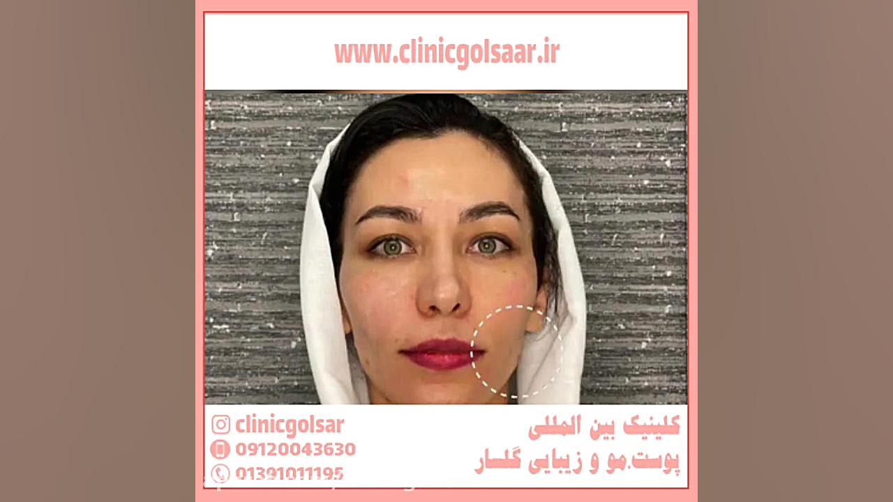 مراقبت های بعد از هایفوتراپی پزشکی هیپر باریک