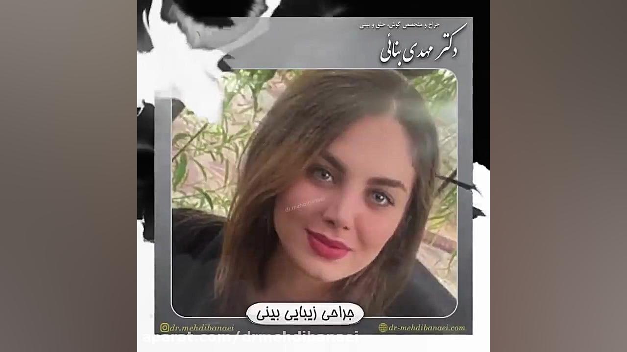 عمل زیبایی بینی