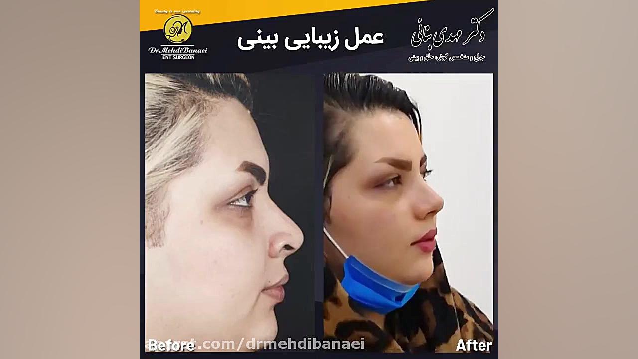 جراحی زیبایی بینی