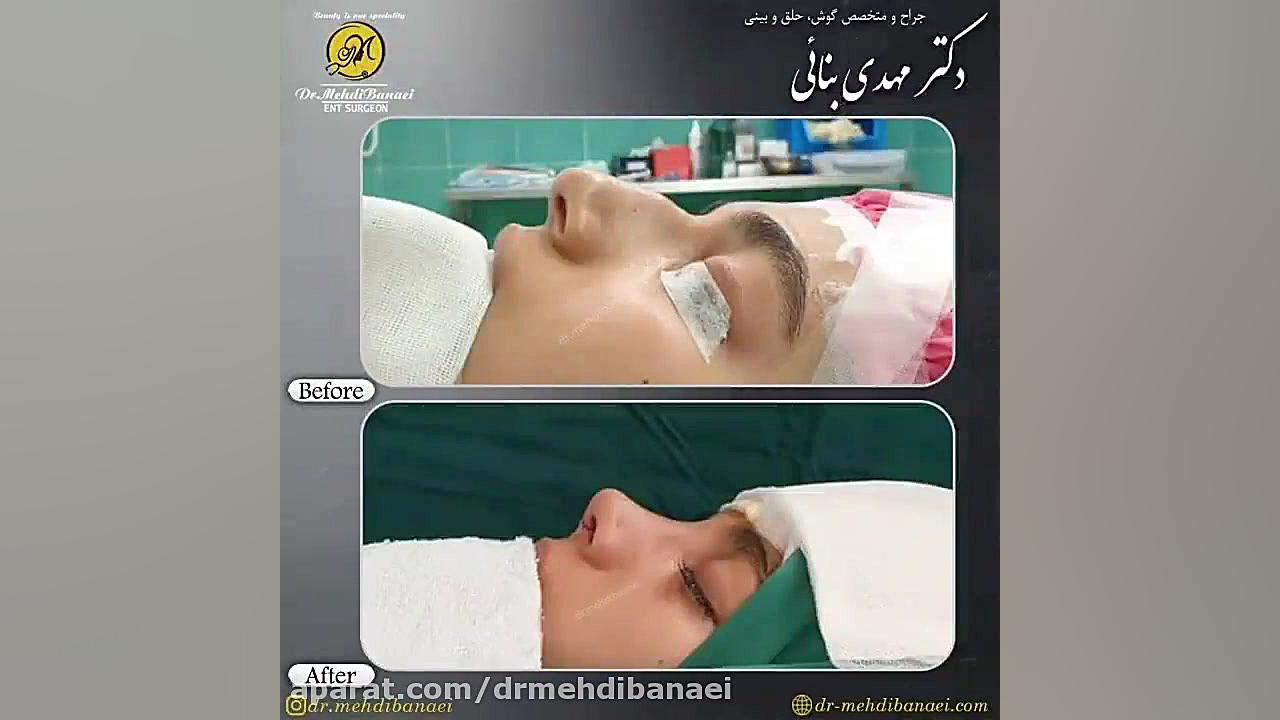 جراحی زیبایی بینی و رفع افتادگی آن