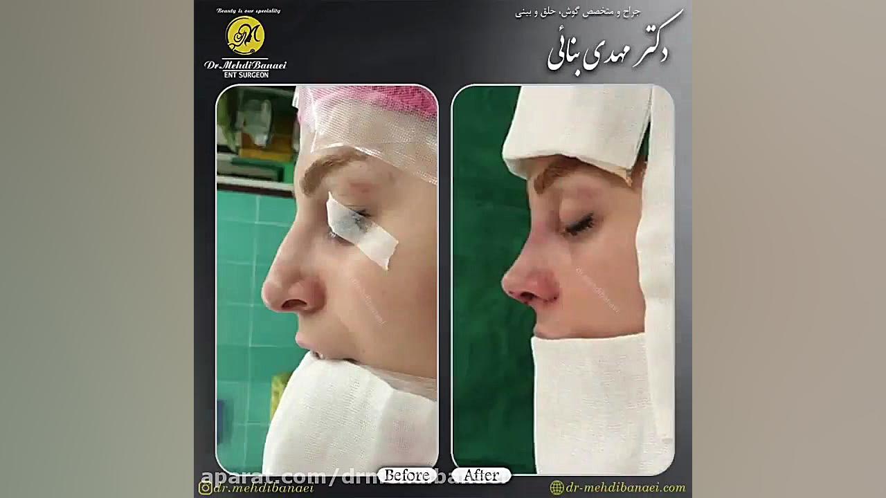 عمل زیبایی بینی و رفع افتادگی نوک آن