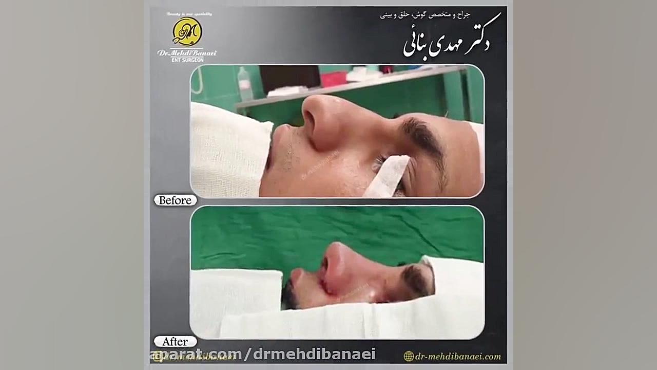 عمل زیبایی بینی و رفع افتادگی نوک آن