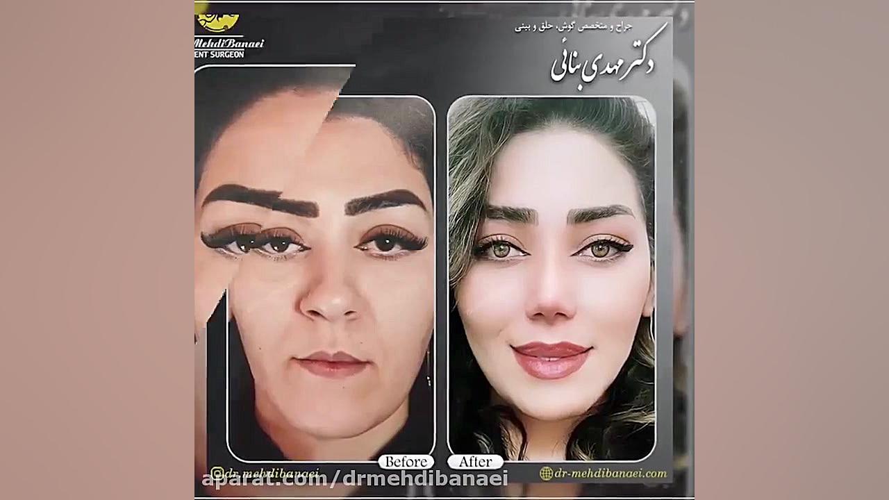 عمل زیبایی بینی و کوچک کردن نوک آن