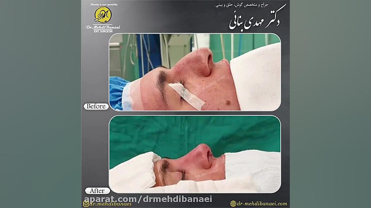 عمل زیبایی بینی و کوچک کردن حفره های آن