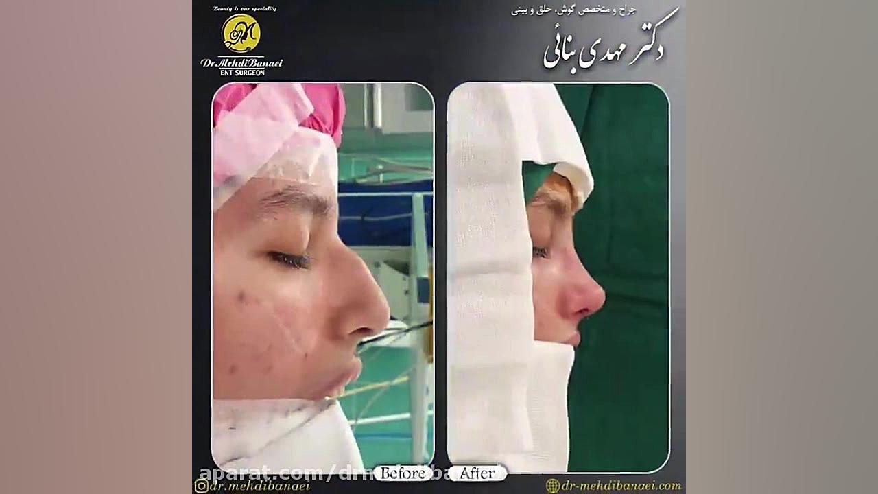 جراحی زیبایی بینی استخوانی