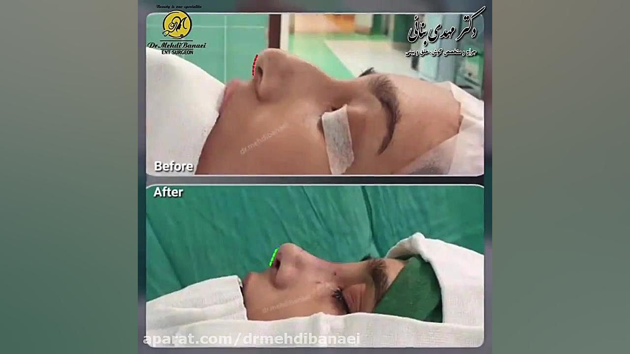 جراحی زیبایی بینی