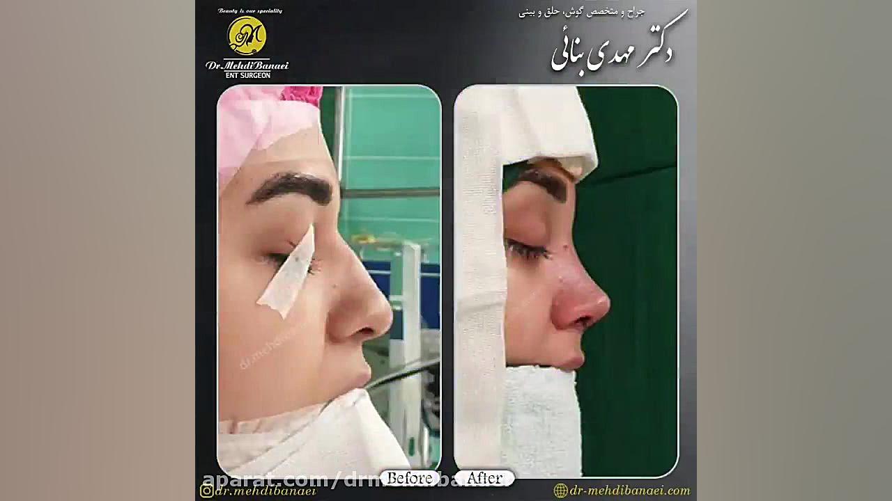 عمل زیبایی بینی و رفع افتادگی نوک بینی