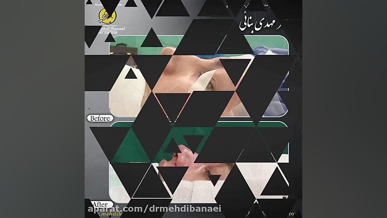 عمل زیبایی بینی