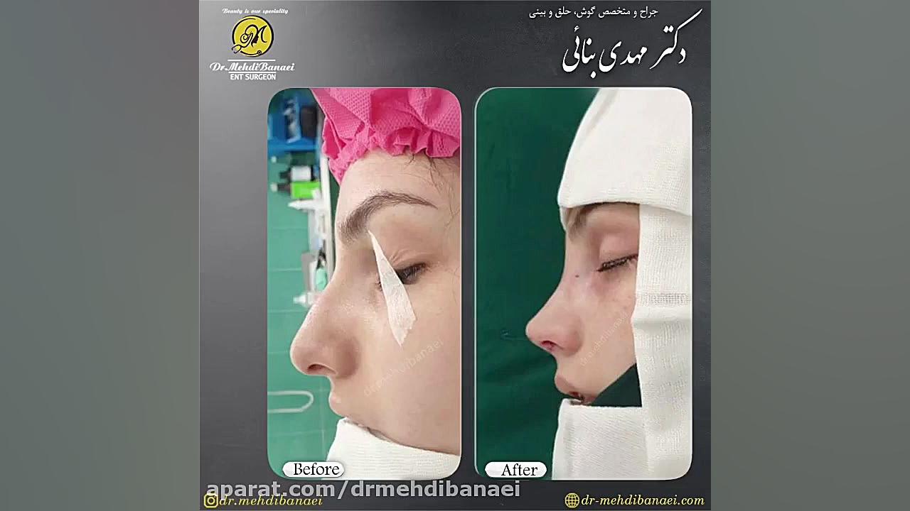جراحی زیبایی بینی استخونی