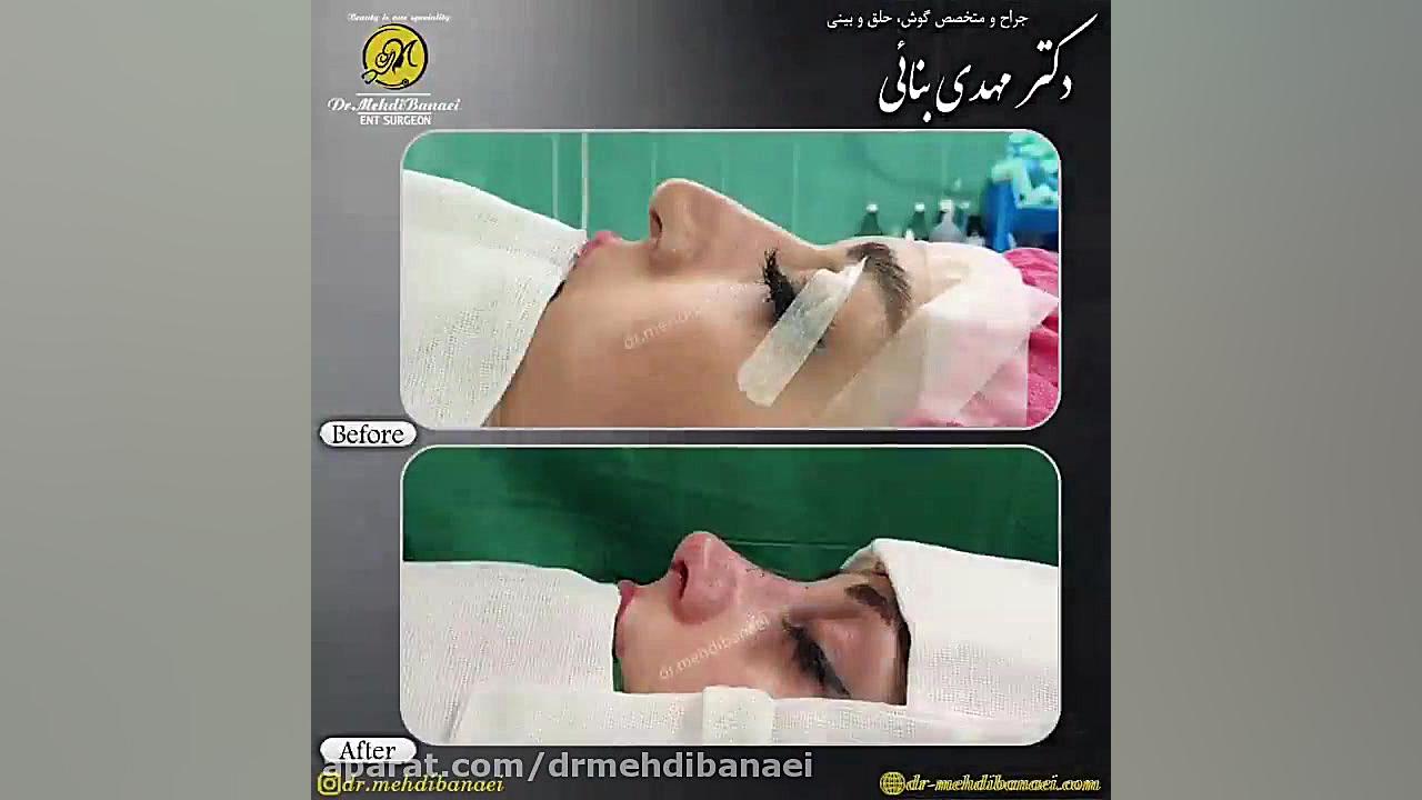 جراحی زیبایی بینی و رفع افتادگی نوک آن