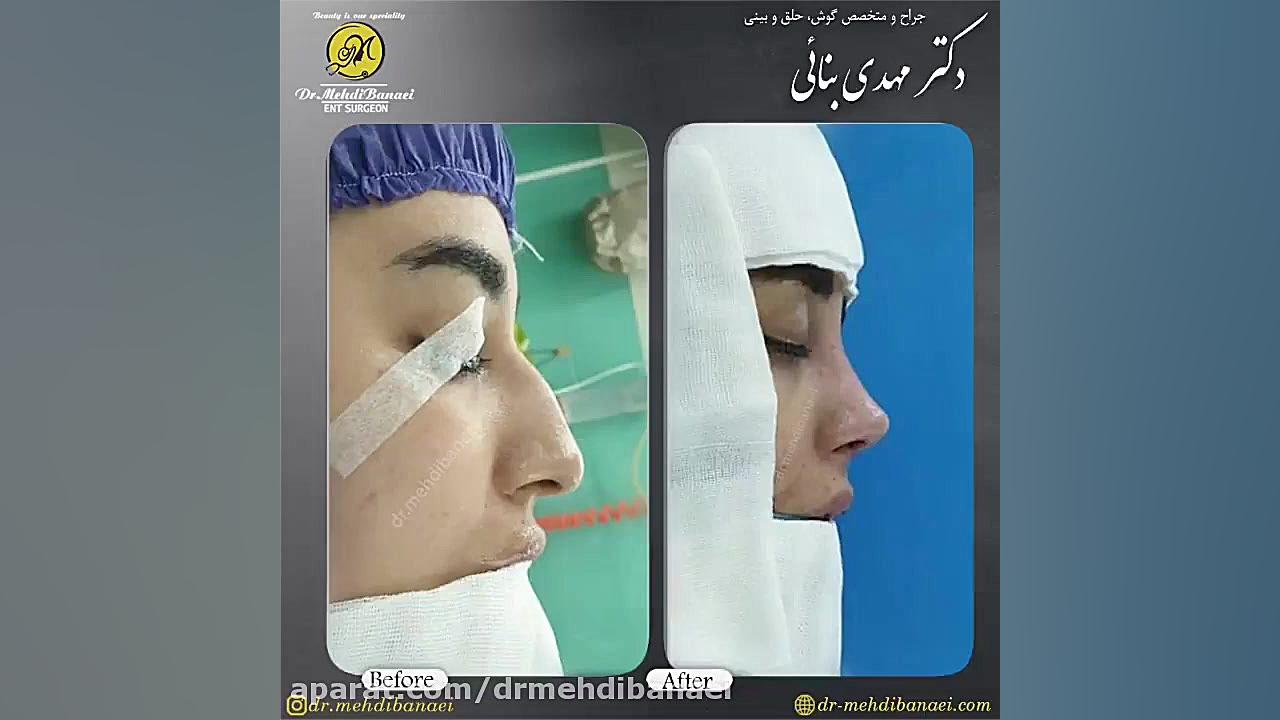 عمل زیبایی بینی استخوانی و رقع قوز آن