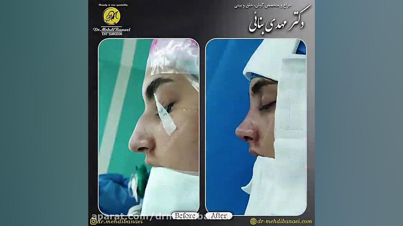 جراحی بینی و رفع قوز آن