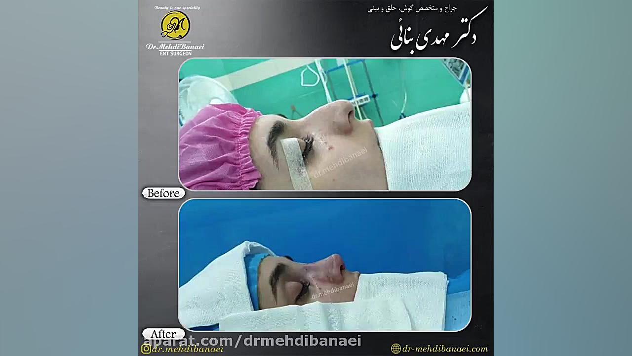 جراحی زیبایی بینی