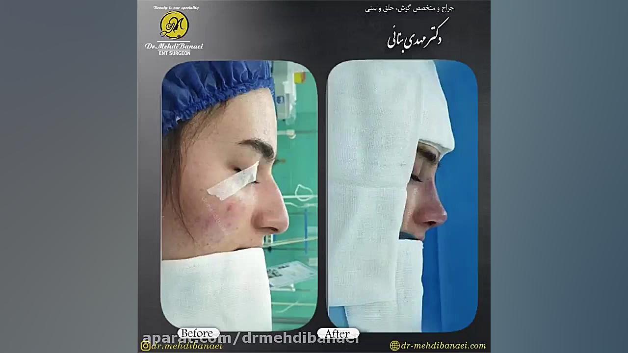 عمل زیبایی بینی و رفع افتادگی نوک آن
