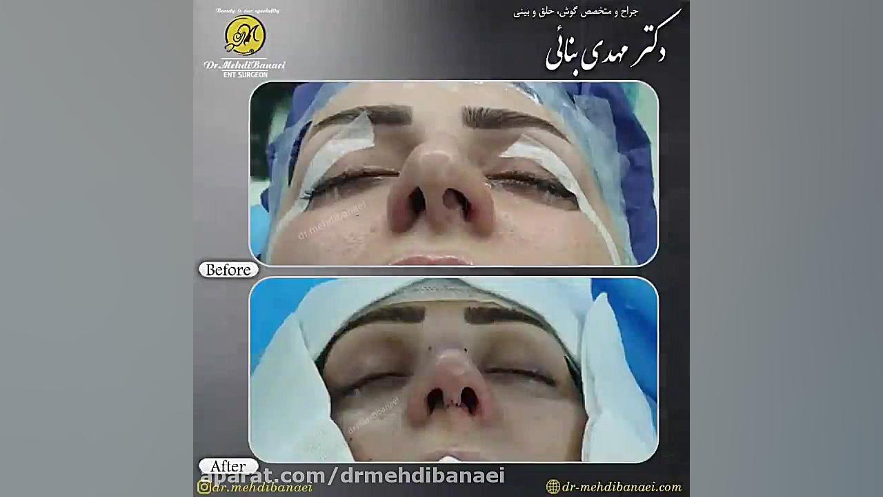 جراحی زیبایی بینی