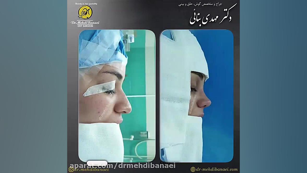 جراحی زیبایی بینی و رفع افتادگی نوک آن