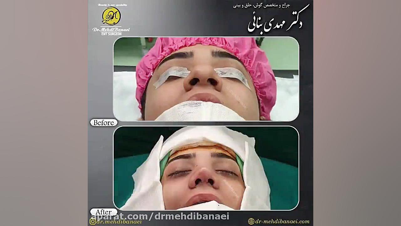 جراحی زیبایی بینی گوشتی