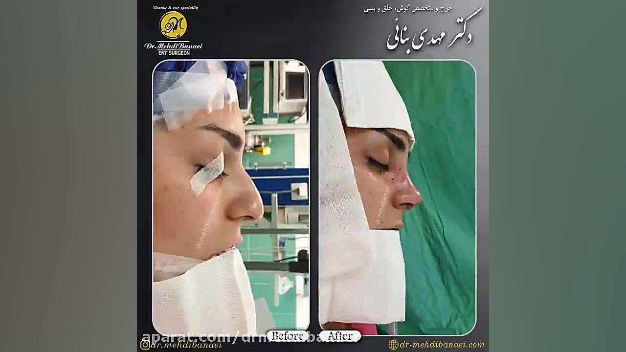 عمل زیبایی بینی استخوانی
